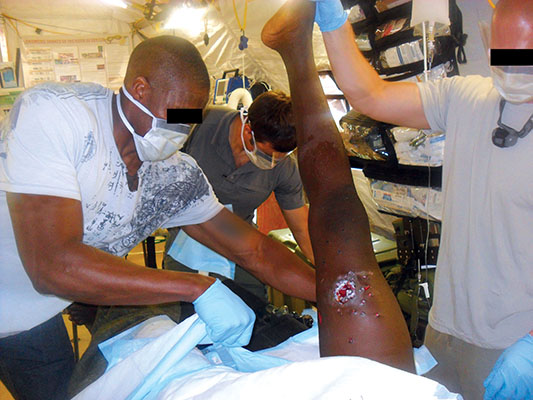 SSG Anthony J. Watson*, an 18D, and CPT Haynes* examine the leg of a local man who accidentally shot himself with a shotgun.